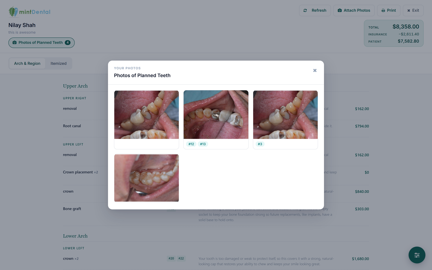 Present Mode with the Photos of Planned Teeth gallery open, showing four photos with their teeth tags.